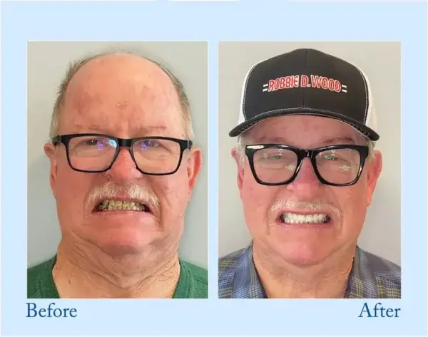 Custom-Fit Functional Dentures — Perfectly Fitted in Minutes at Home - Image 12