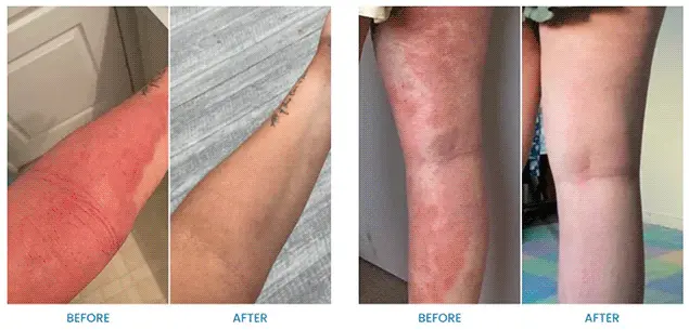 All Natural Eczema Soothing Cream - Image 3