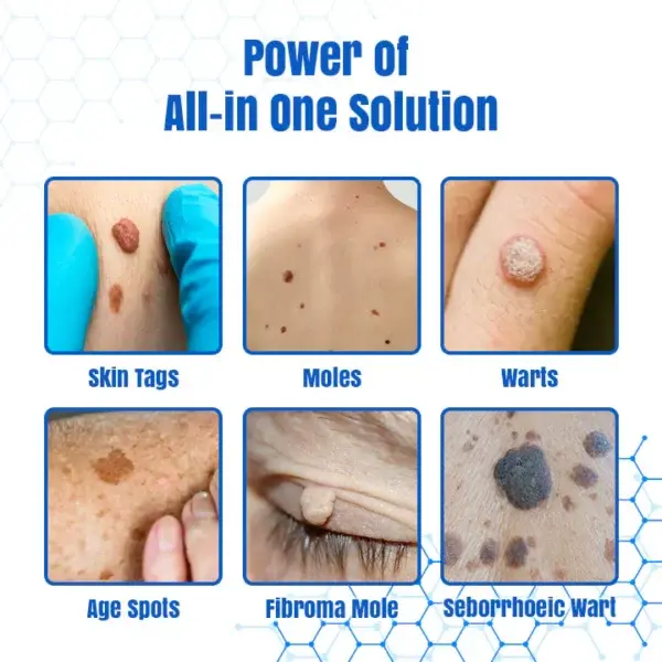 DermZap Mole & Wart Removal Laser Pen - Image 3