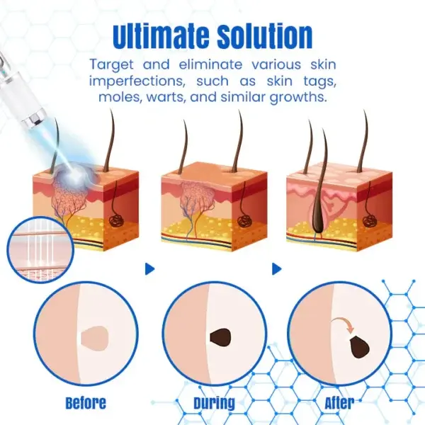 DermZap Mole & Wart Removal Laser Pen - Image 5