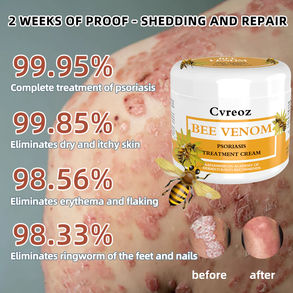 Cvreoz Bee Venom Psoriasis Treatmen - Image 2