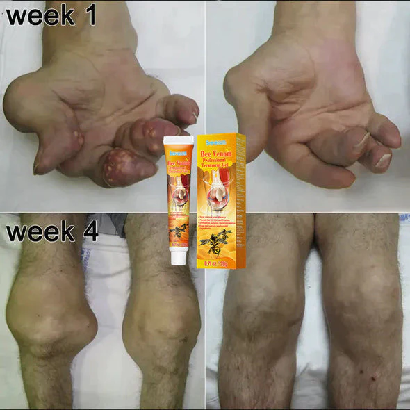 Flashing New Zealand Bee Venom Professional Treatment Gel - Image 2