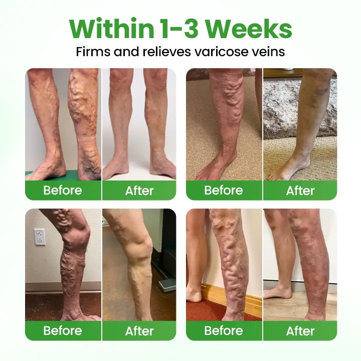 VeinHeal Microneedle Patch - Image 2