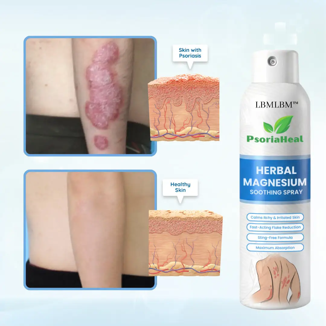 PsoriaHeal Herbal Magnesium Soothing Spray - Image 3