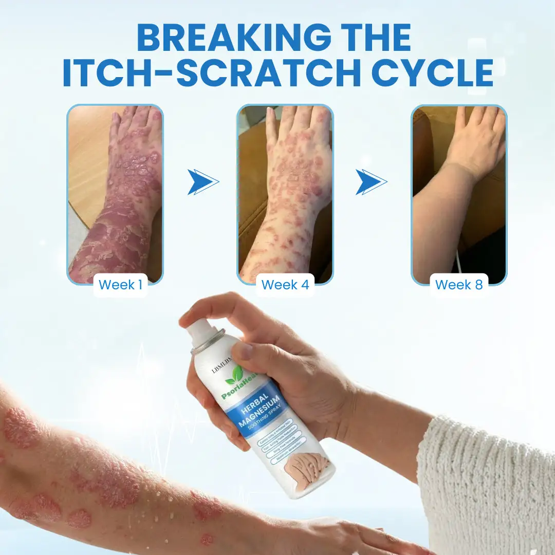 PsoriaHeal Herbal Magnesium Soothing Spray - Image 4