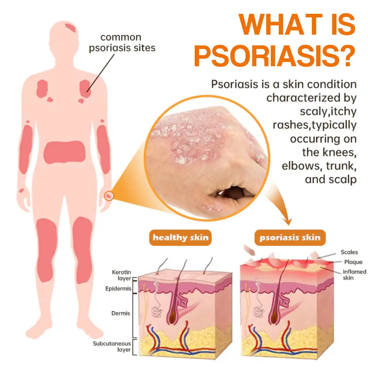 PsoriaHeal psoriasis Spray pro - Image 2