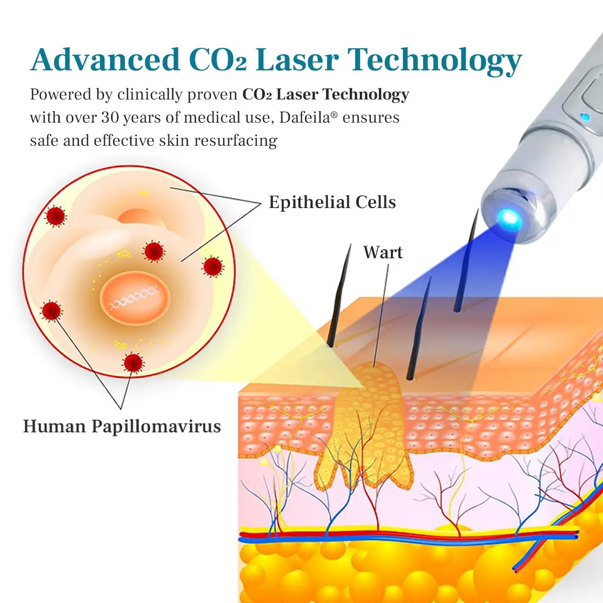 Non-invasive Mole and Wart Removal Laser Pen - Image 5