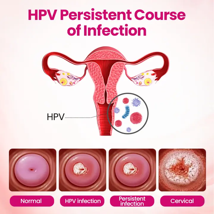 IntiDefend Anti-HPV Interferon Gel - Image 2