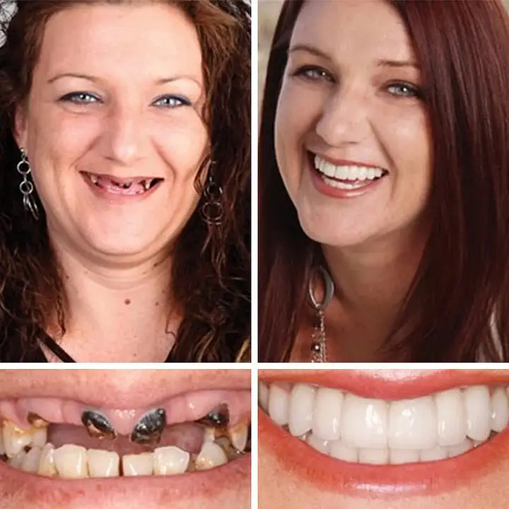 Medical Full Denture with Strong Suctiond - Image 11