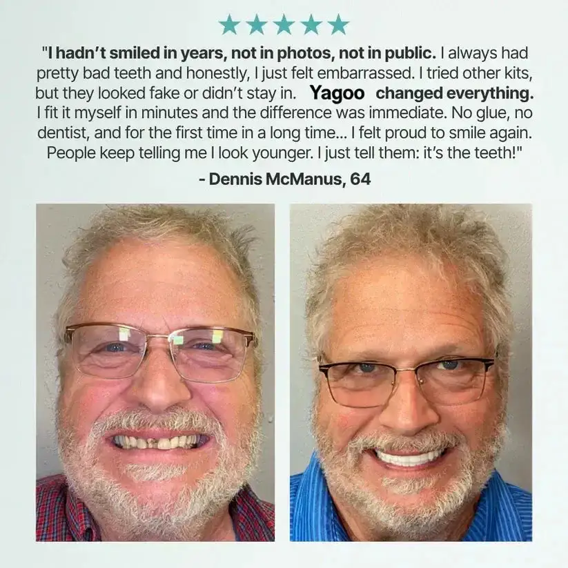 Medical Full Denture with Strong Suctiond - Image 17