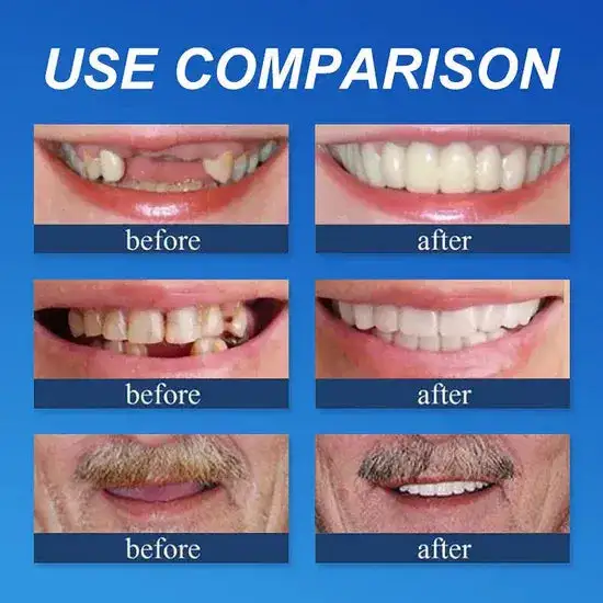 Medical Full Denture with Strong Suctiond - Image 20