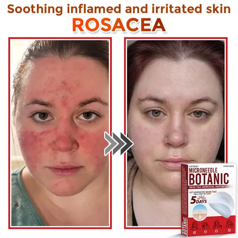 MicroNeedle Botanic Skin Tag Removal Patch - Image 6