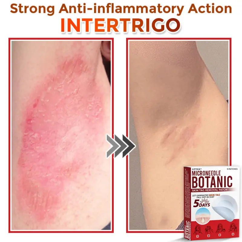 MicroNeedle Botanic Skin Tag Removal Patch - Image 9