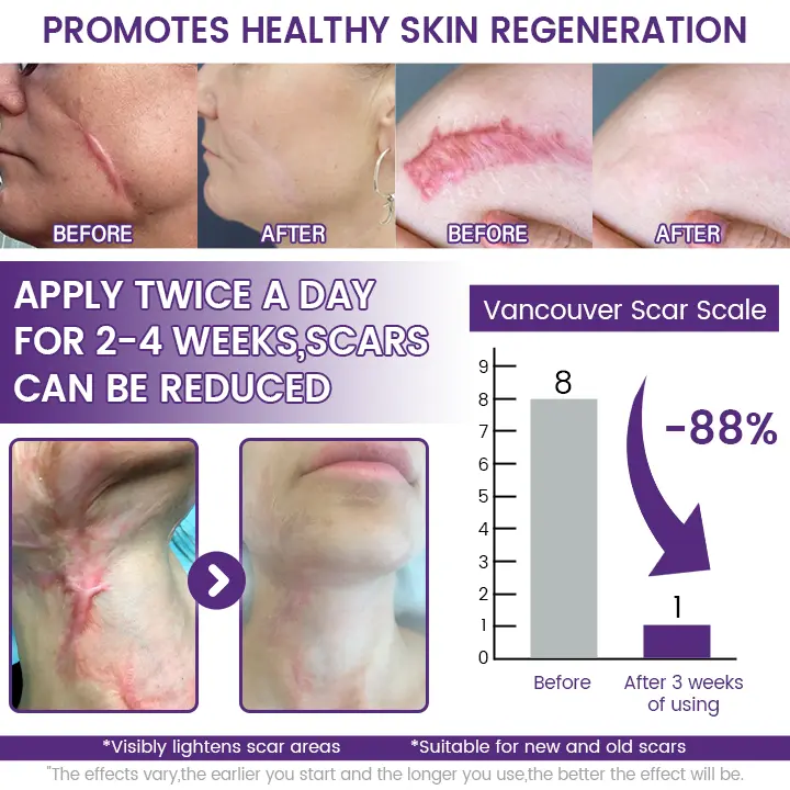 ReGenScar Stem Cell Scar Gel - Image 4