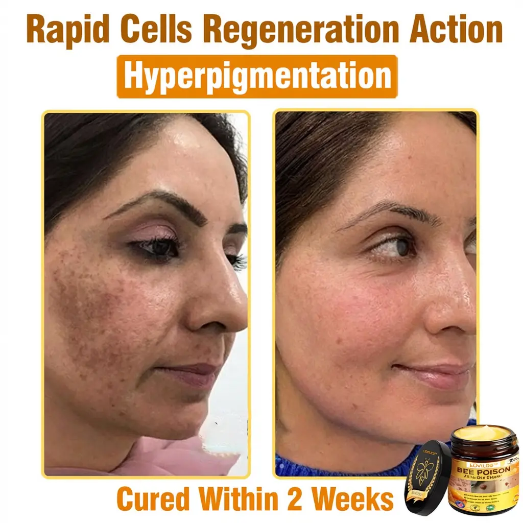 𝐁𝐞𝐞 𝐏𝐨𝐢𝐬𝐨𝐧 𝐀𝐥𝐥-𝐢𝐧-𝐎𝐧𝐞 𝐂𝐫𝐞𝐚𝐦–🌸 Anti-aging,Hydrating, Skin Repair, Even Tone, Acne and Dark Spot Treatment, Wart and Mole Removal, Psoriasis Relief - Image 11