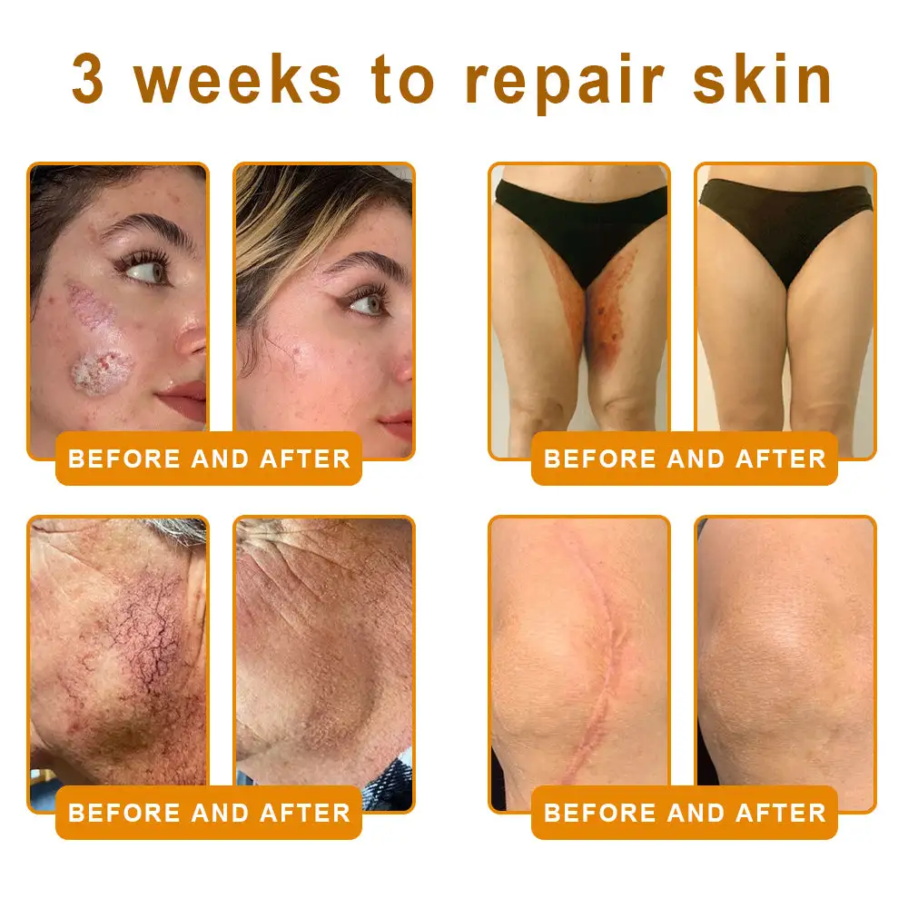 𝐁𝐞𝐞 𝐏𝐨𝐢𝐬𝐨𝐧 𝐀𝐥𝐥-𝐢𝐧-𝐎𝐧𝐞 𝐂𝐫𝐞𝐚𝐦–🌸 Anti-aging,Hydrating, Skin Repair, Even Tone, Acne and Dark Spot Treatment, Wart and Mole Removal, Psoriasis Relief - Image 4