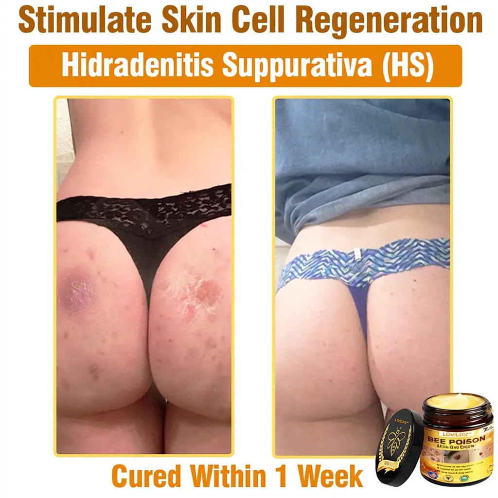 𝐁𝐞𝐞 𝐏𝐨𝐢𝐬𝐨𝐧 𝐀𝐥𝐥-𝐢𝐧-𝐎𝐧𝐞 𝐂𝐫𝐞𝐚𝐦–🌸 Anti-aging,Hydrating, Skin Repair, Even Tone, Acne and Dark Spot Treatment, Wart and Mole Removal, Psoriasis Relief - Image 9