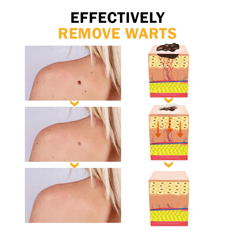 FlawlessFix Mole & Wart Removal Cream - Image 4
