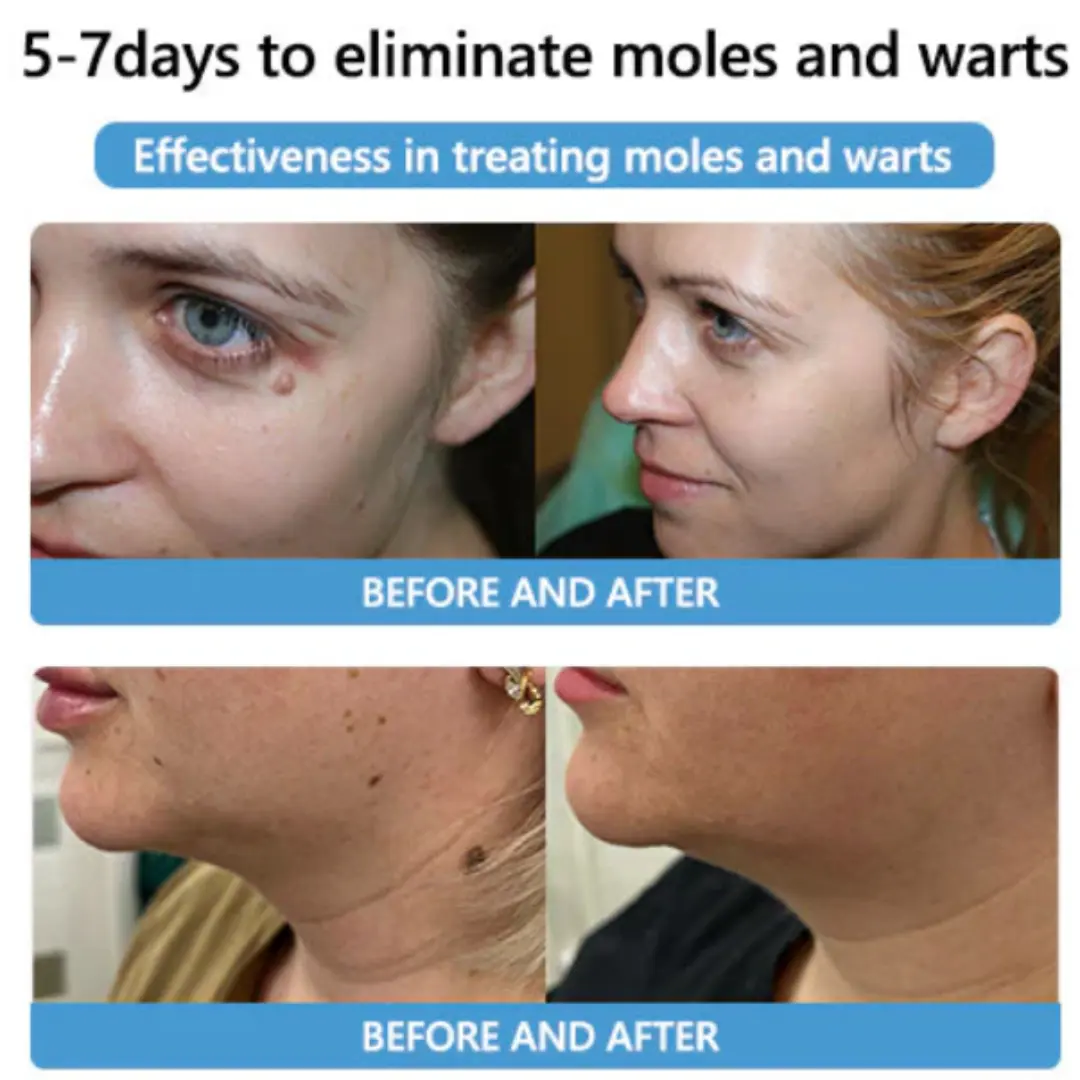Bee Venom Mole and Wart Treatment Cream - LIMITED-TIME OFFER - Image 19