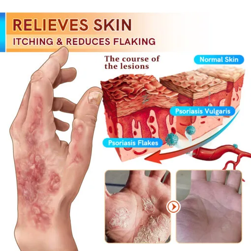 PsoriaCare Psoriasis Treatment Cream - Image 3