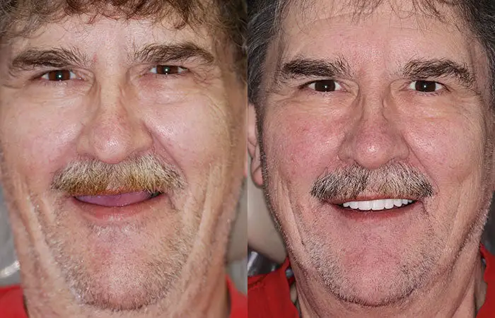 Premium Denture - Image 9