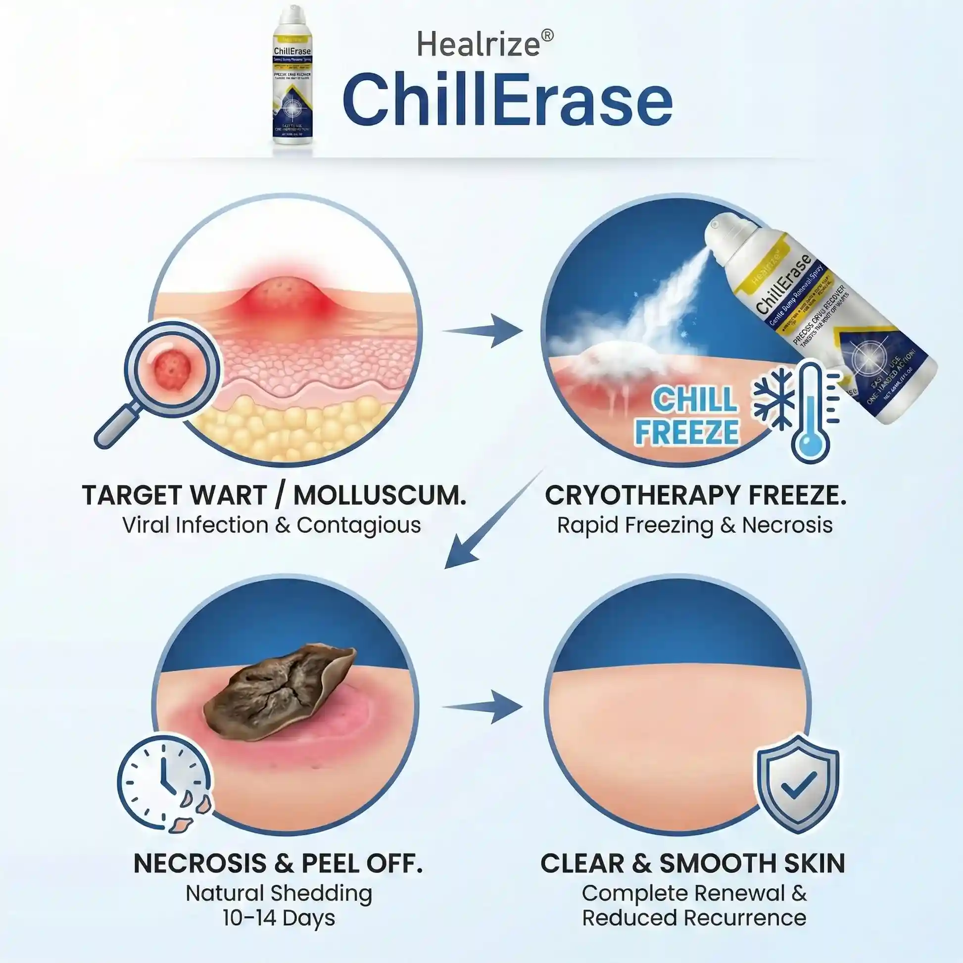ChillErase Gentle Bump Renewal Spray✨ — Pain-Free, Acid-Free Gentle Wart Removal - Image 4