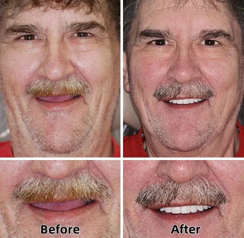 -Advanced Custom-Fit Functional Dentures - Image 3