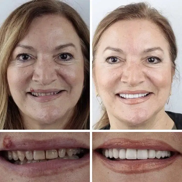 Medical Full Denture with Strong Suctiond Custom-Fit Full Functional Dentures - Image 12