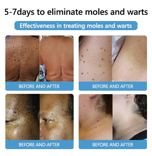 PRO Bee Venom Mole and Wart Treatment Cream - Image 4