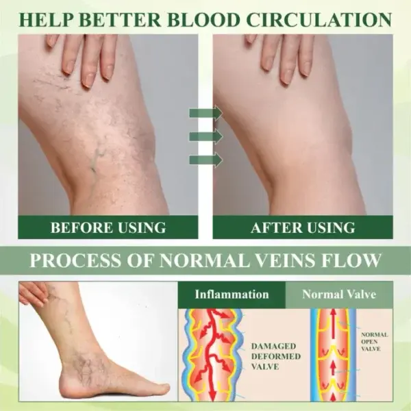Leg Therapy Edema Cream - Image 7