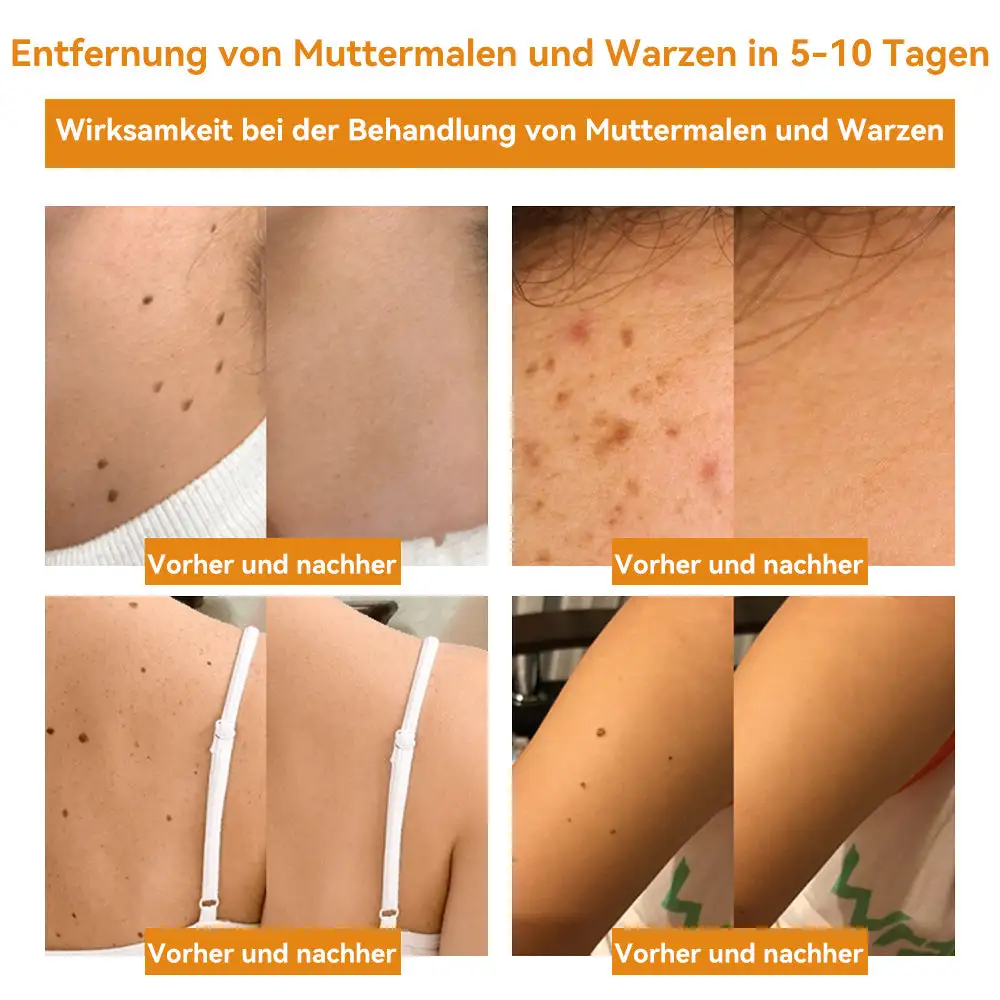 Bienengift Waren & Muttermalenfernung Creme - Image 13