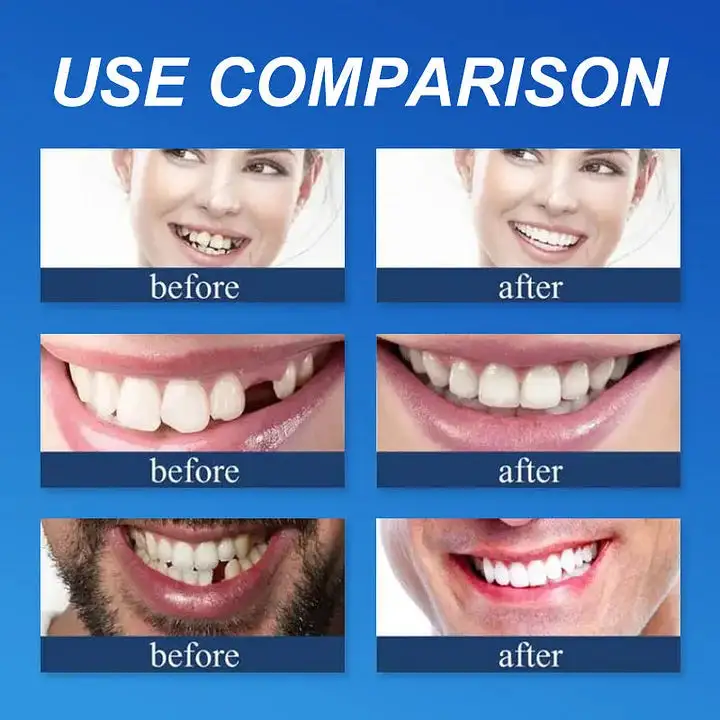 Medical Full Denture with Strong Suctiond Custom-Fit Full Functional Dentures - Image 4