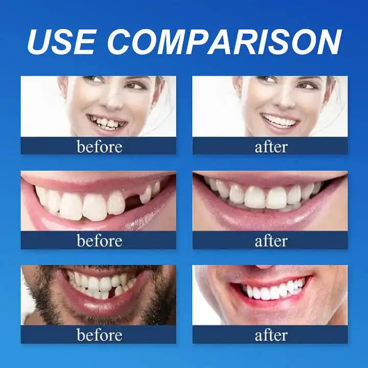 Medical Full Denture with Strong Suctiond Custom-Fit Full Functional Dentures - Image 6
