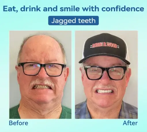 Premium Denture AdaptableFit Functional Dentures - Image 8