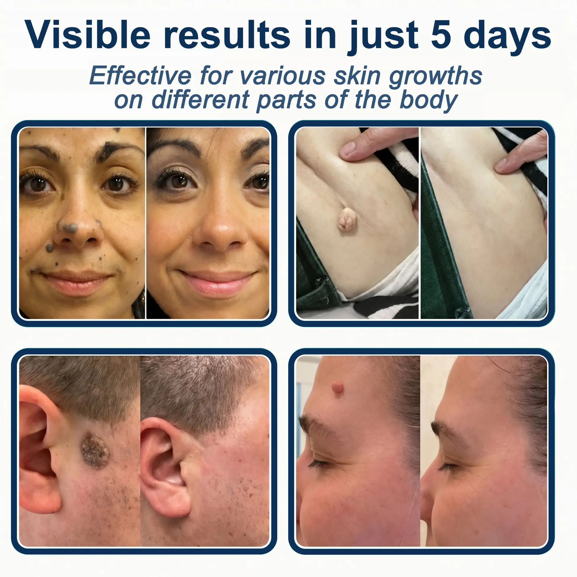 2-in-1 Microneedle & Hydrocolloid Patch - Image 2