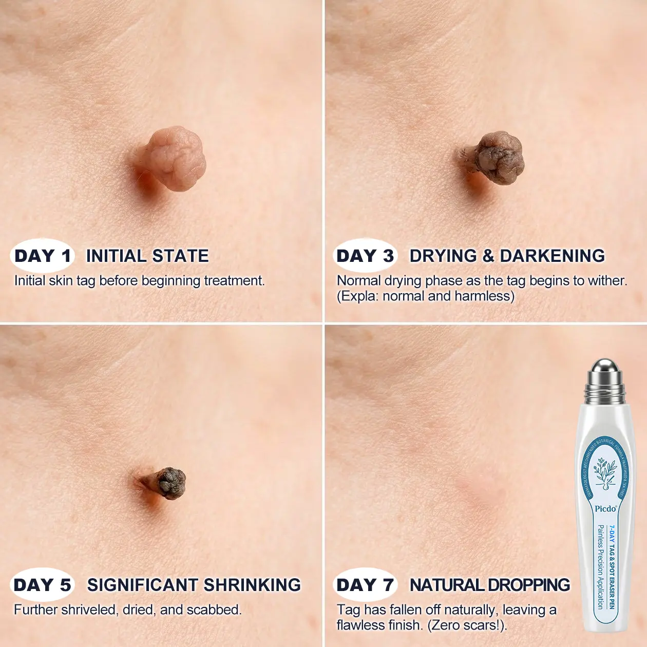 7-Day Skin Tag & Spot Remover Serum - Image 4