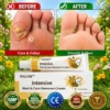 Intensive Wart & Corn Remover Cream
