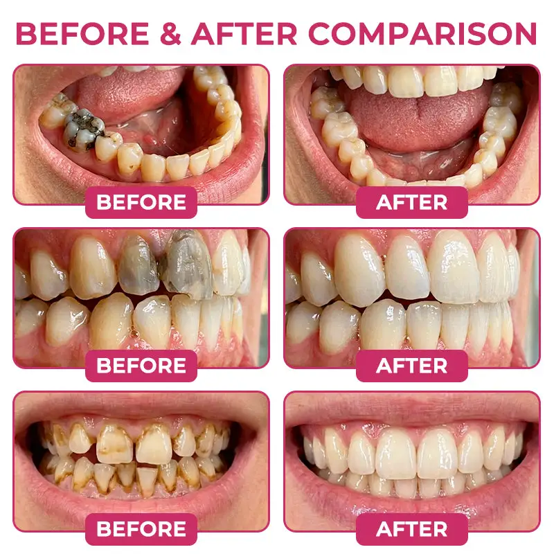 Cavity-Repair Natural Enamel Filling Gel - Image 2