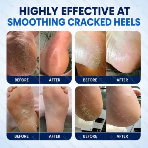 Medical-Grade 2% Salicylic Acid Callus & Cracked Heel Repair Spray - Image 4