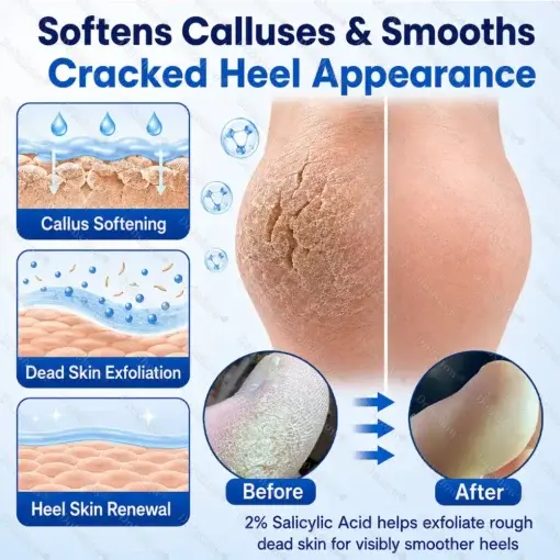 Medical-Grade 2% Salicylic Acid Callus & Cracked Heel Repair Spray - Image 5