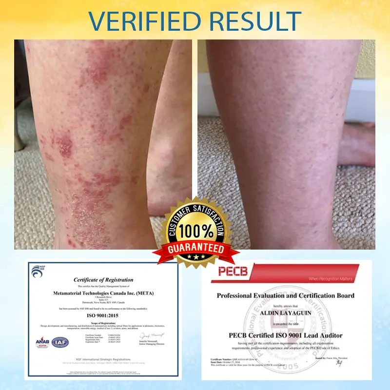 PsoriasisCare Mellifera Venom Skin Healing Spray - Image 4