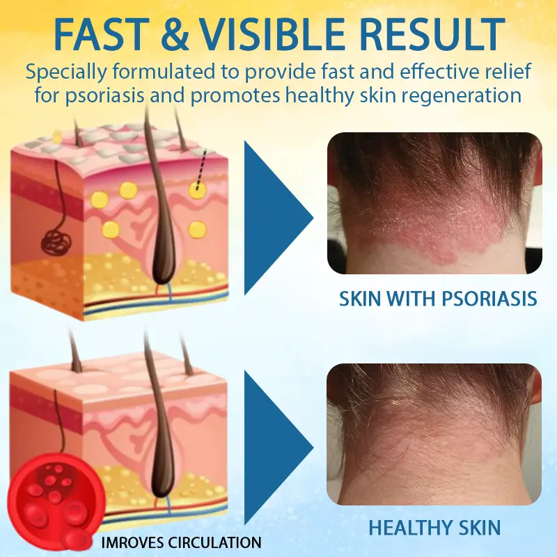 PsoriasisCare Mellifera Venom Skin Healing Spray - Image 5