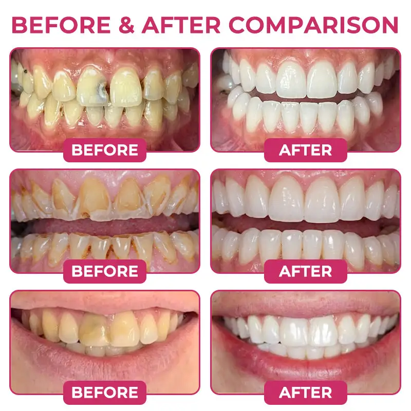DenPerm Cavity-Repair Natural Enamel - Image 3
